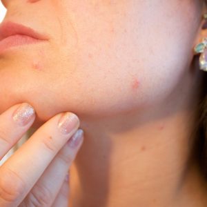 natural remedies acne scars
