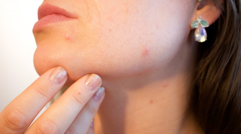 natural remedies acne scars
